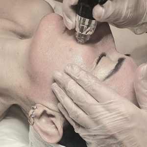 ​Tratamiento Facial Global Lift (Dermapen )