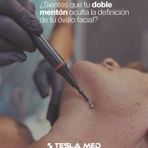 Tesla Reductor y reafirmación de Cuello